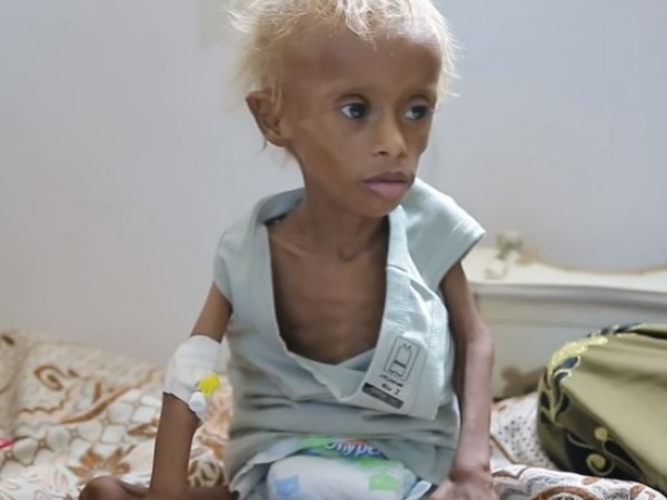 Йемен страда от най-тежката хуманитарна криза на планетата. Два милиона